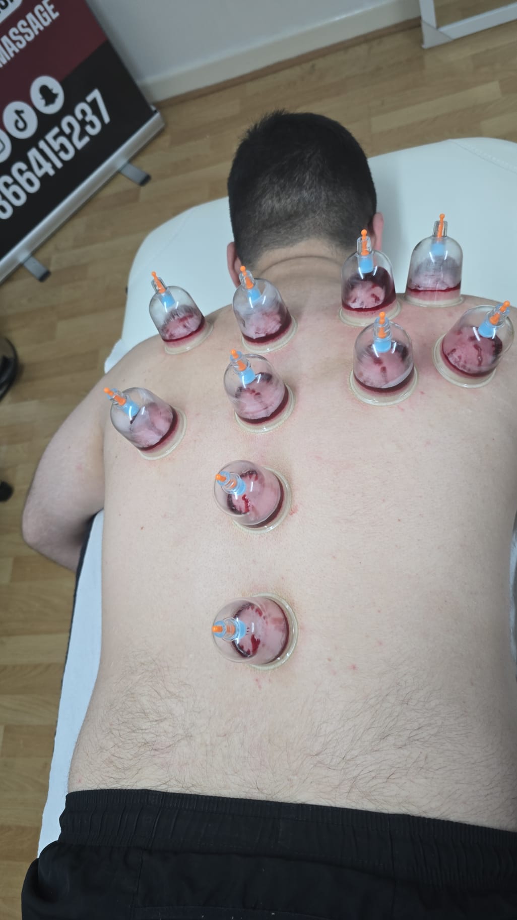 Full back wet cupping treatment